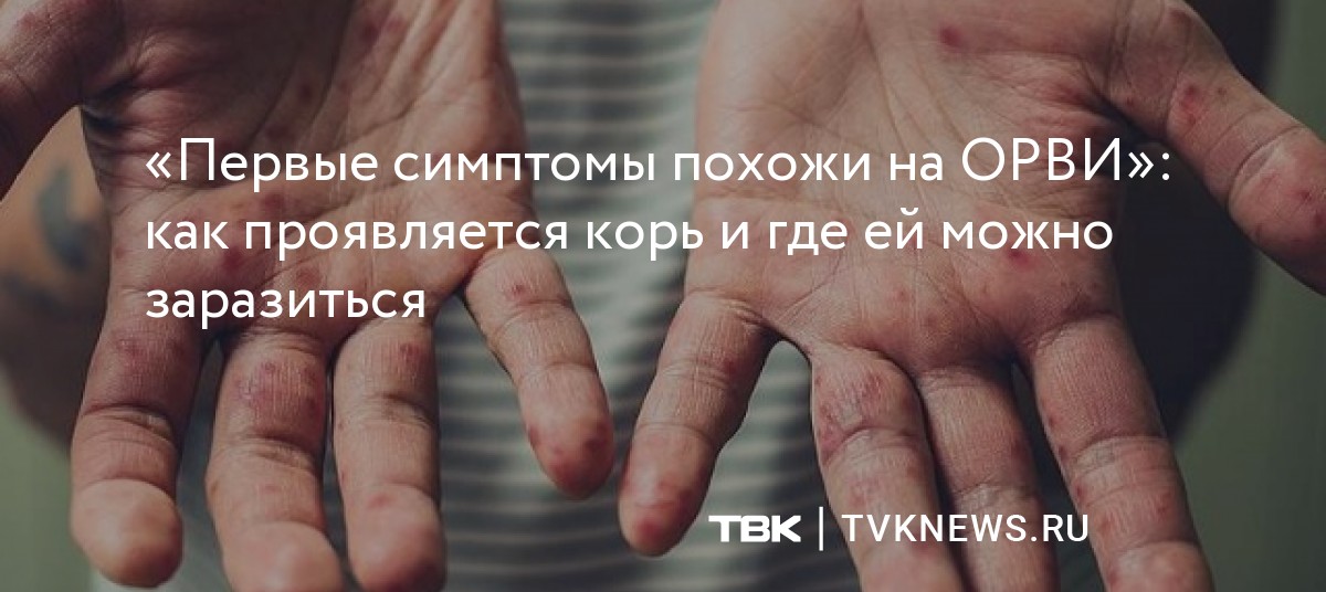 «Первые симптомы похожи на ОРВИ»: как проявляется корь и где ей можно ...