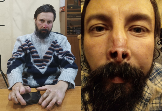 «Год провел в рабстве»: мужчина сбежал с вахты на севере Красноярского края и потерял пальцы и нос