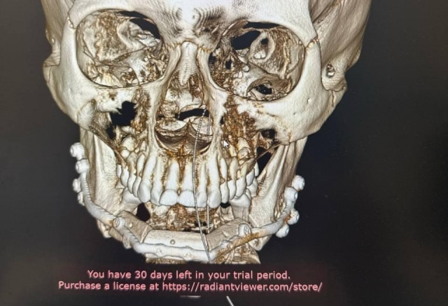 Хирурги воссоздали красноярке челюсть из кости ноги