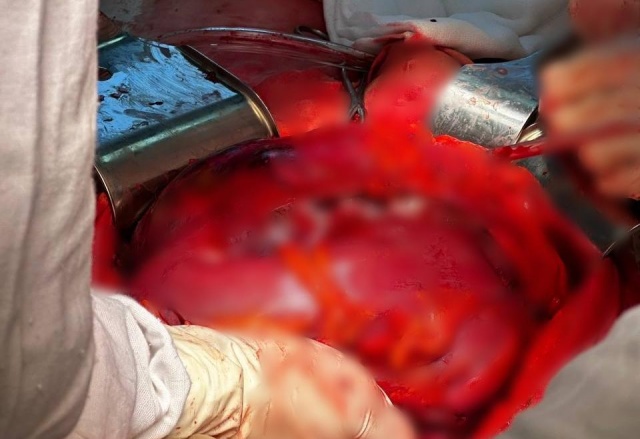 Опухоль размером с футбольный мяч удалили мужчине в Красноярске