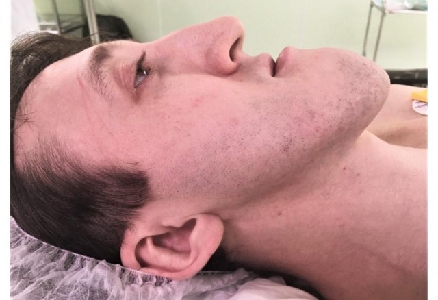 «Не мог жевать и внятно разговаривать»: красноярские врачи прооперировали пациента с аномально большой челюстью