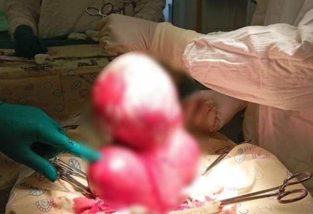 Опухоль размером с голову удалили из матки красноярки 