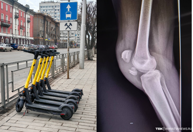 Врачи рассказали, какие травмы чаще всего получают самокатчики в Красноярске