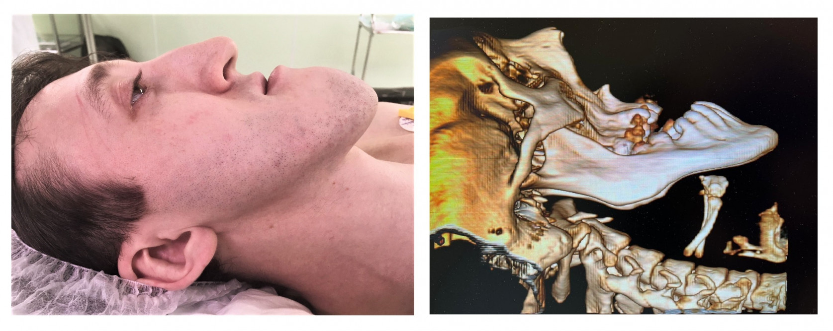 Не мог жевать и внятно разговаривать»: красноярские врачи прооперировали  пациента с аномально большой челюстью