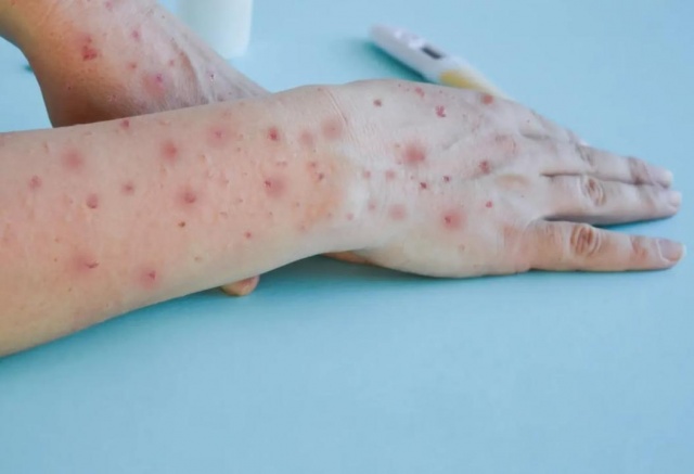 Пациента с оспой обезьян госпитализировали в Москве