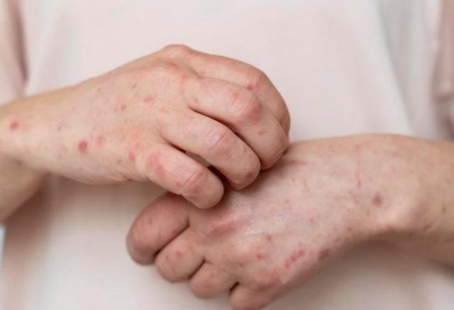 В Красноярском крае выявили пятый случай заболевания корью