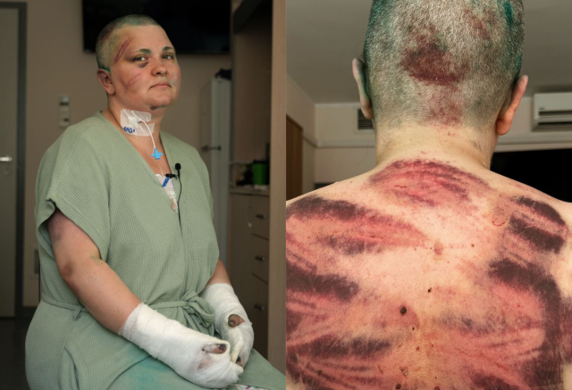 После нападения на журналистку Милашину завели уголовное дело