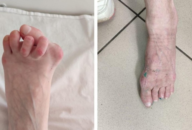 Красноярские врачи исправили пациентке тяжелую деформацию стопы: теперь она может ходить