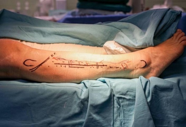 Красноярские хирурги восстановили пациентке челюсть с помощью кости из ее ноги