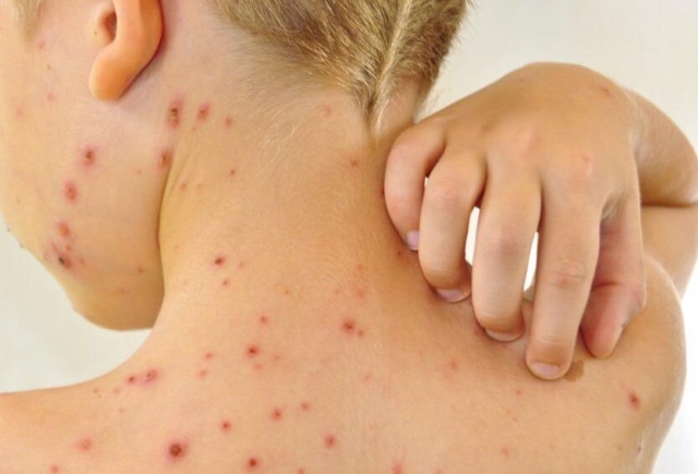 Шестой случай заболевания корью выявили в Красноярском крае