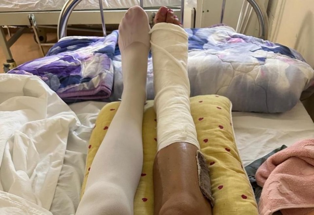 Красноярка сломала ногу после аварии в Таиланде: ее собирали по частям