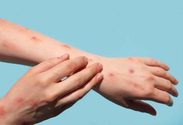 В Красноярском крае выявили седьмой случай кори